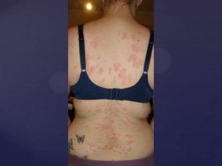 Post Gardasil Skin & Inflammatory Reactions - Patient ZVK 