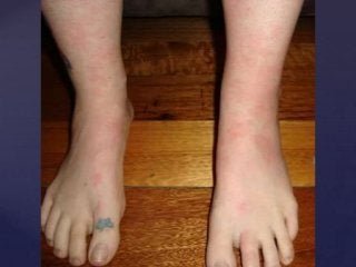 Post Gardasil Skin & Inflammatory Reactions - Patient ZVK 