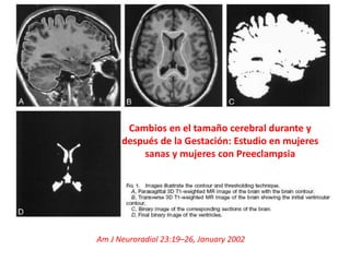 Cambios en el tamaño cerebral durante y
después de la Gestación: Estudio en mujeres
sanas y mujeres con Preeclampsia
Am J Neuroradiol 23:19–26, January 2002
 