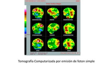 Tomografía Computarizada por emisión de foton simple
 