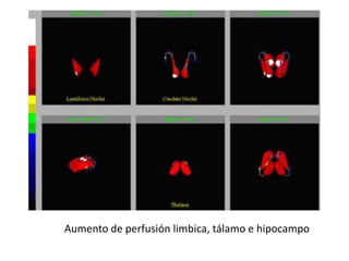 Aumento de perfusión limbica, tálamo e hipocampo
 