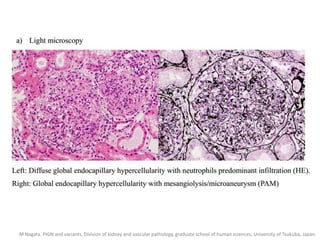 M Nagata. PIGN and variants. Division of kidney and vascular pathology, graduate school of human sciences, University of Tsukuba, Japan.
 