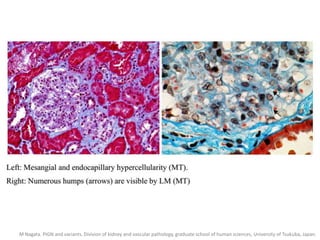 M Nagata. PIGN and variants. Division of kidney and vascular pathology, graduate school of human sciences, University of Tsukuba, Japan.
 