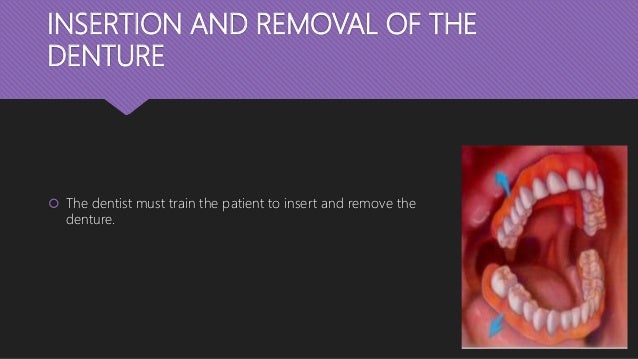 Post insertion instructions in complete denture patients