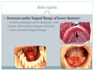 Sore spots
 Soreness under lingual flange of lower denture:
 Centric occlusion not in harmony with
centric, drives lower denture forward
 Over-extended lingual flange
 