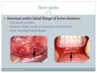 Sore spots
 Soreness under labial flange of lower denture:
 Too much overbite
 Patient’s habit, wants to masticate in protrusive
 Over-extended labial flange
HTTP://www.rxdentistry.net
 