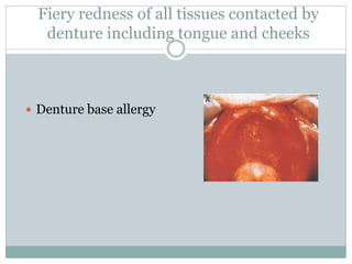 Fiery redness of all tissues contacted by
denture including tongue and cheeks
 Denture base allergy
 