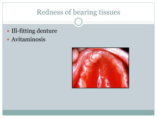 Redness of bearing tissues
 Ill-fitting denture
 Avitaminosis
 