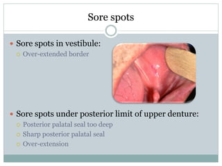 Sore spots
 Sore spots in vestibule:
 Over-extended border
 Sore spots under posterior limit of upper denture:
 Posterior palatal seal too deep
 Sharp posterior palatal seal
 Over-extension
 
