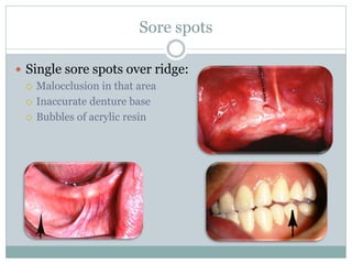 Sore spots
 Single sore spots over ridge:
 Malocclusion in that area
 Inaccurate denture base
 Bubbles of acrylic resin
 