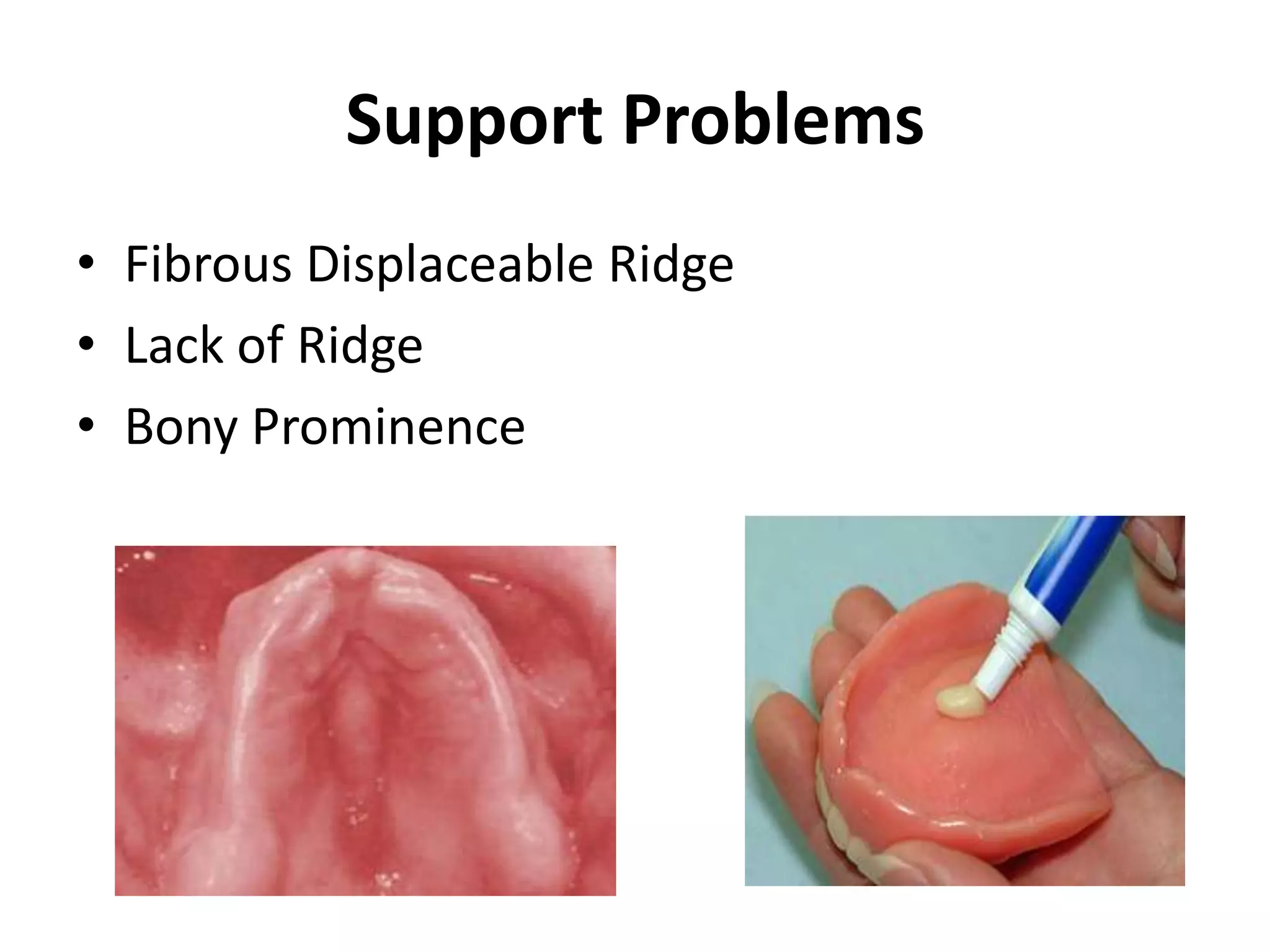Support Problems
• Fibrous Displaceable Ridge
• Lack of Ridge
• Bony Prominence
 