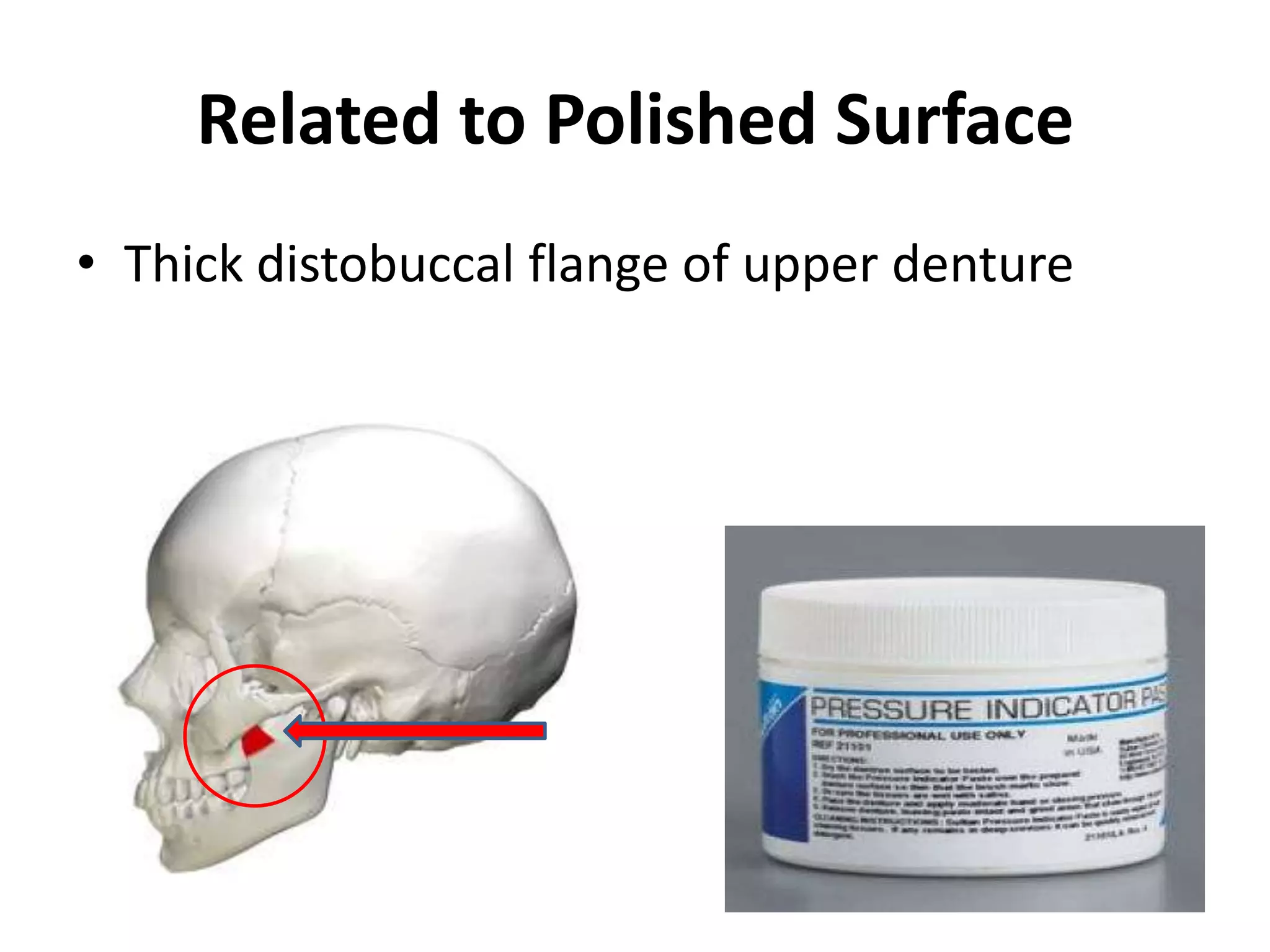 Related to Polished Surface
• Thick distobuccal flange of upper denture
 
