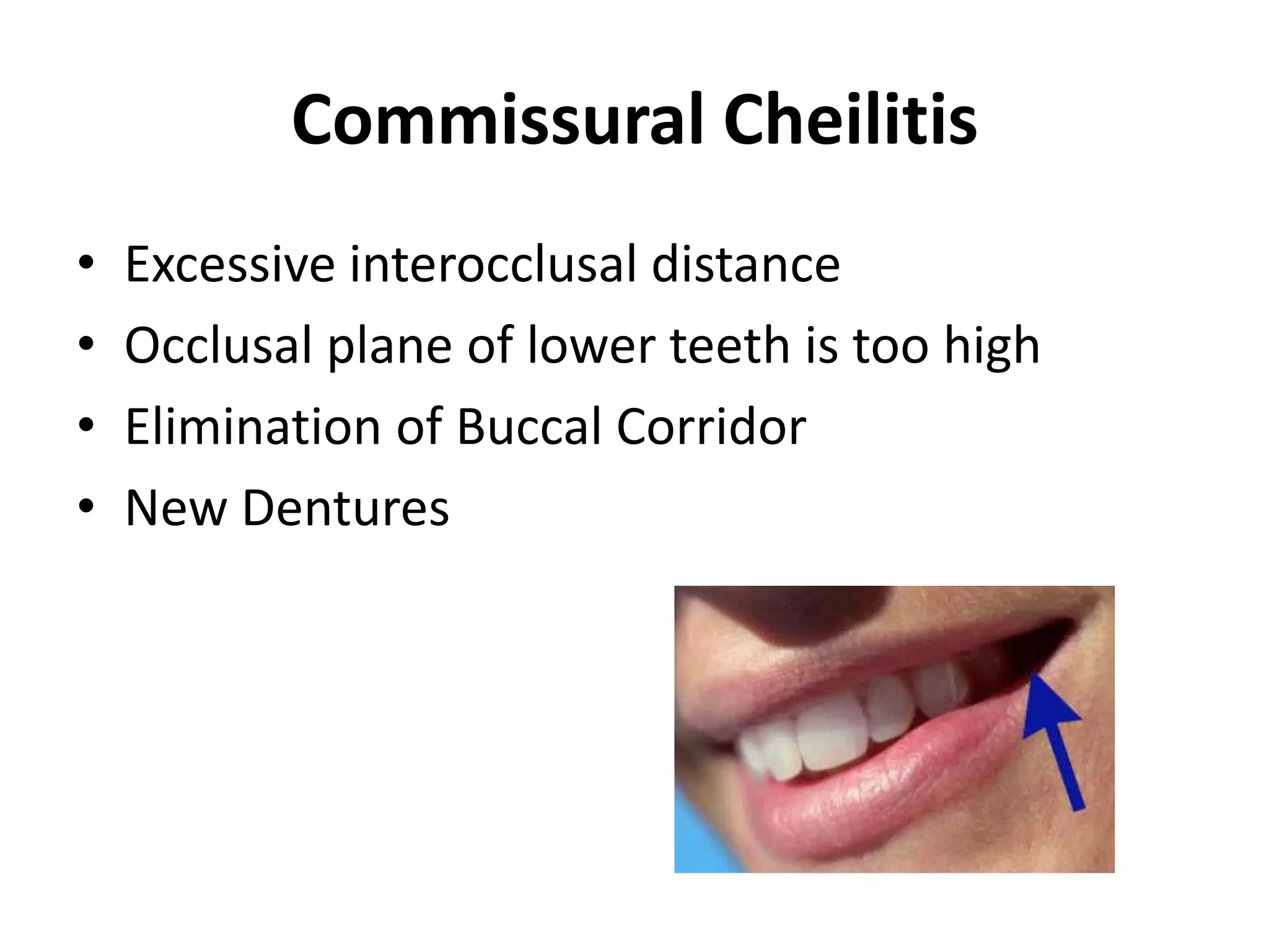 Commissural Cheilitis
• Excessive interocclusal distance
• Occlusal plane of lower teeth is too high
• Elimination of Buccal Corridor
• New Dentures
 