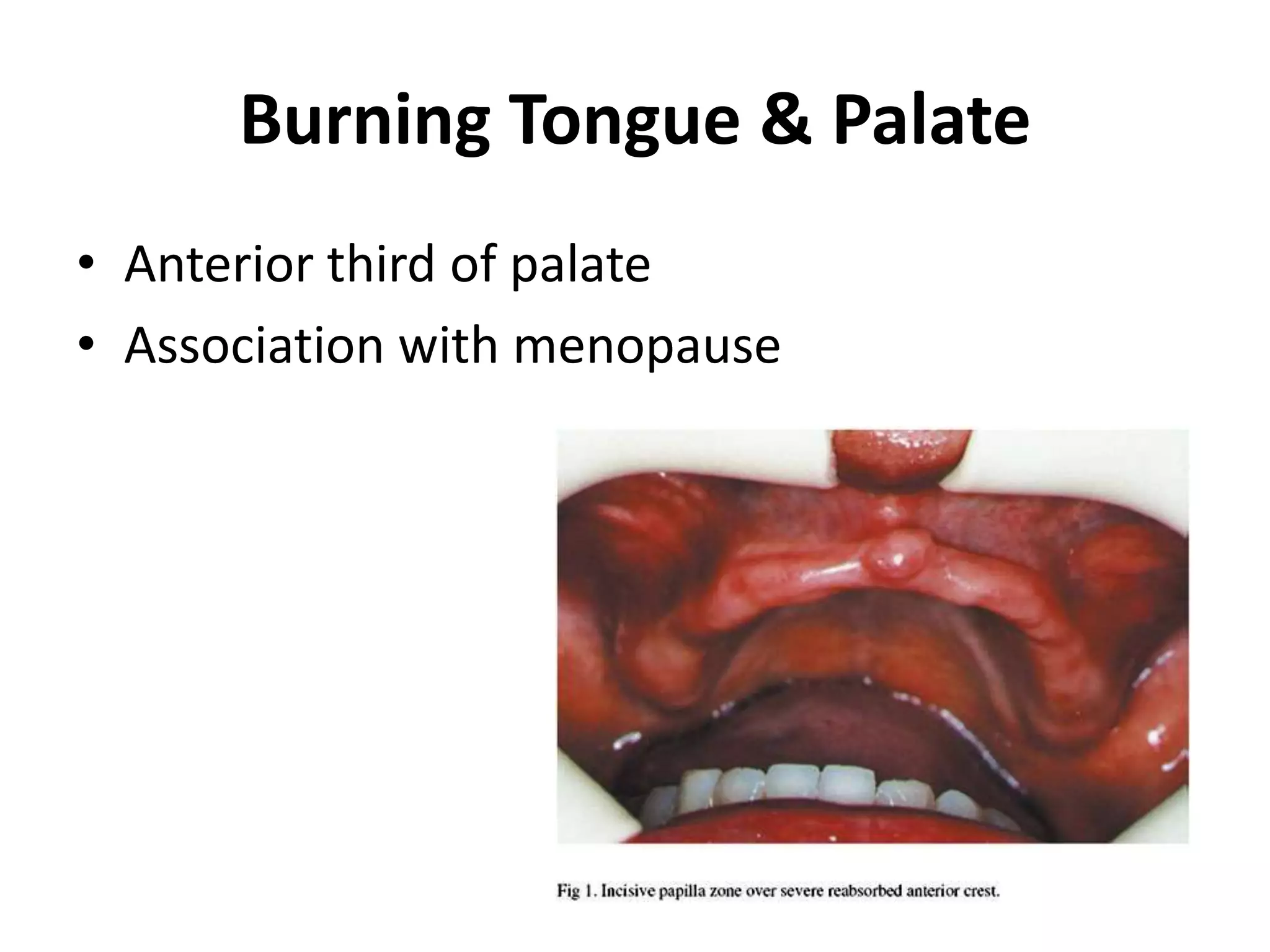 Burning Tongue & Palate
• Anterior third of palate
• Association with menopause
 