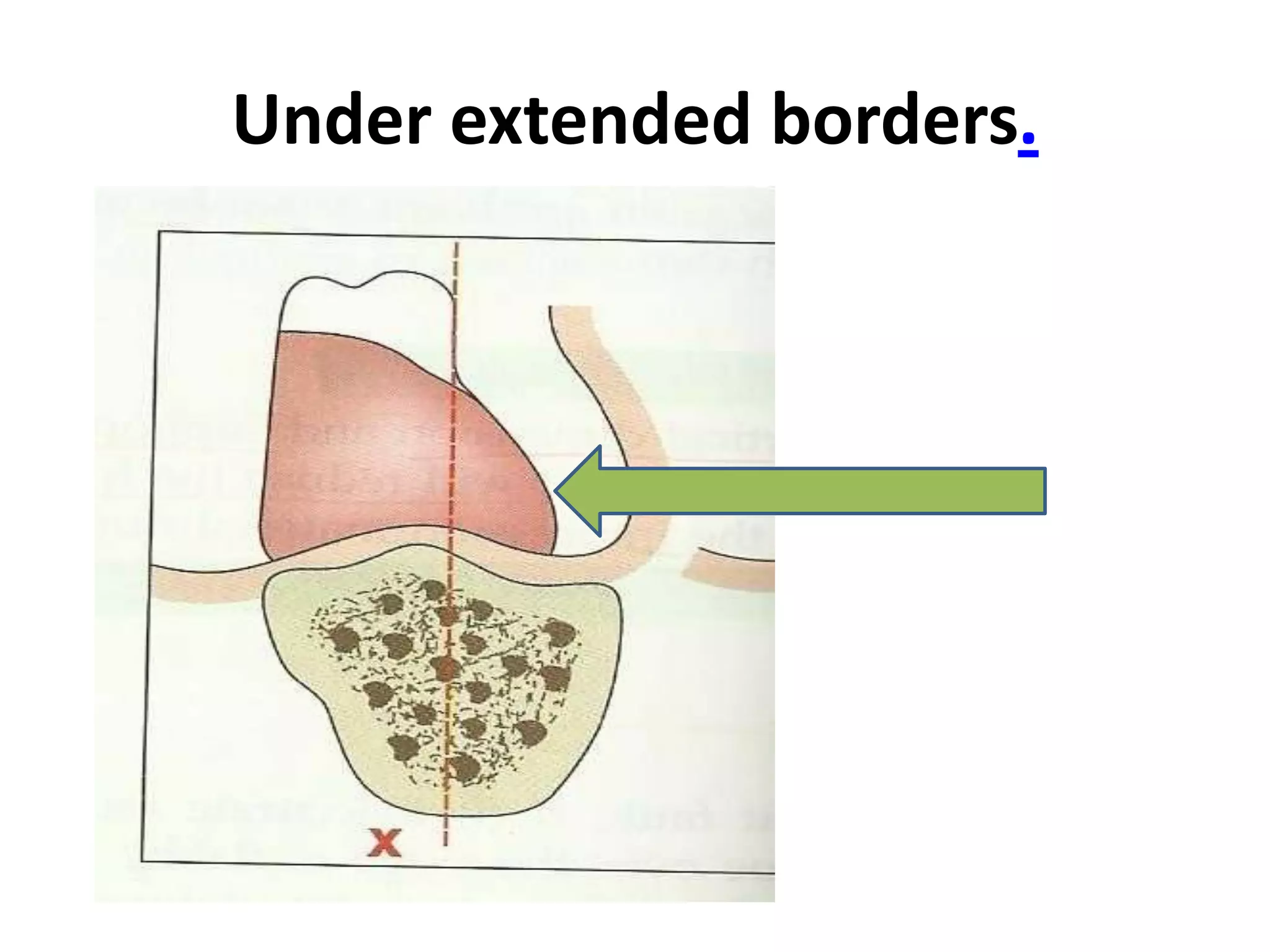 Under extended borders.
 