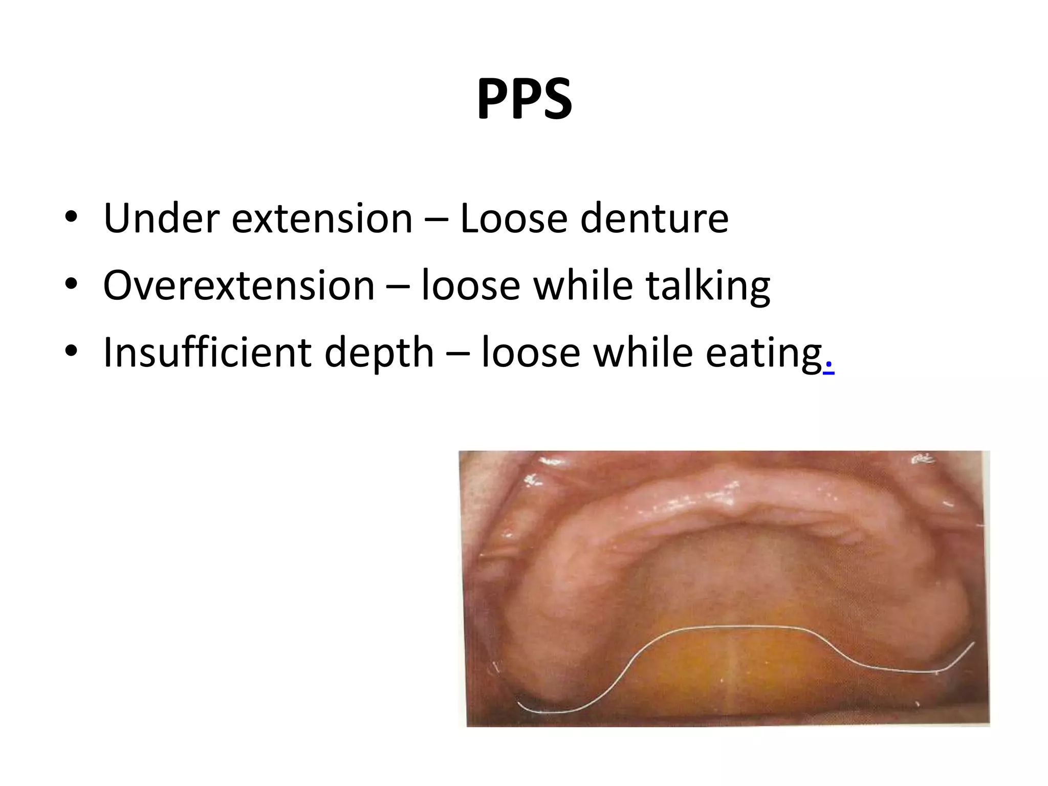 PPS
• Under extension – Loose denture
• Overextension – loose while talking
• Insufficient depth – loose while eating.
 