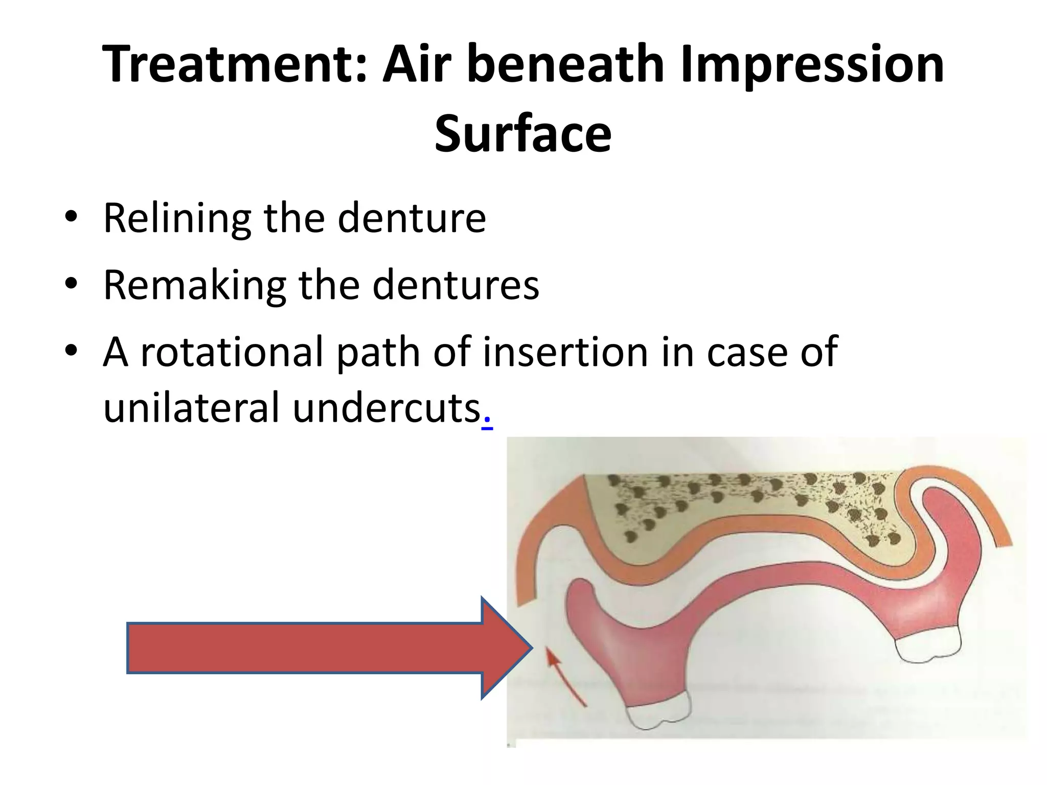 Treatment: Air beneath Impression
Surface
• Relining the denture
• Remaking the dentures
• A rotational path of insertion in case of
unilateral undercuts.
 