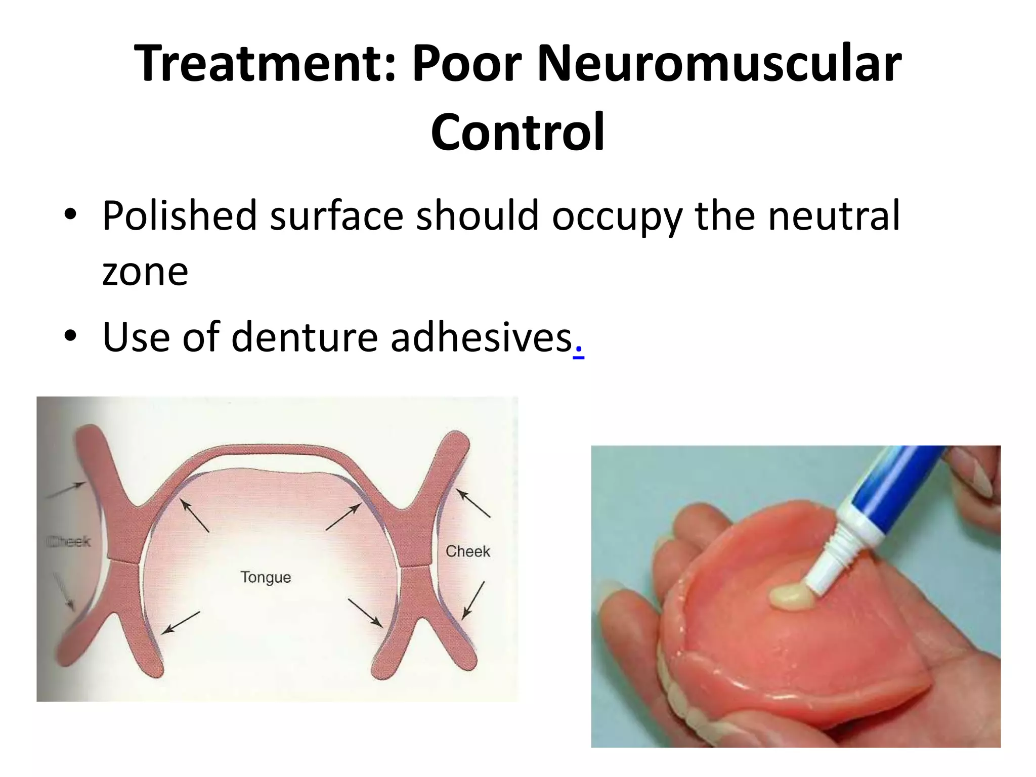 Treatment: Poor Neuromuscular
Control
• Polished surface should occupy the neutral
zone
• Use of denture adhesives.
 