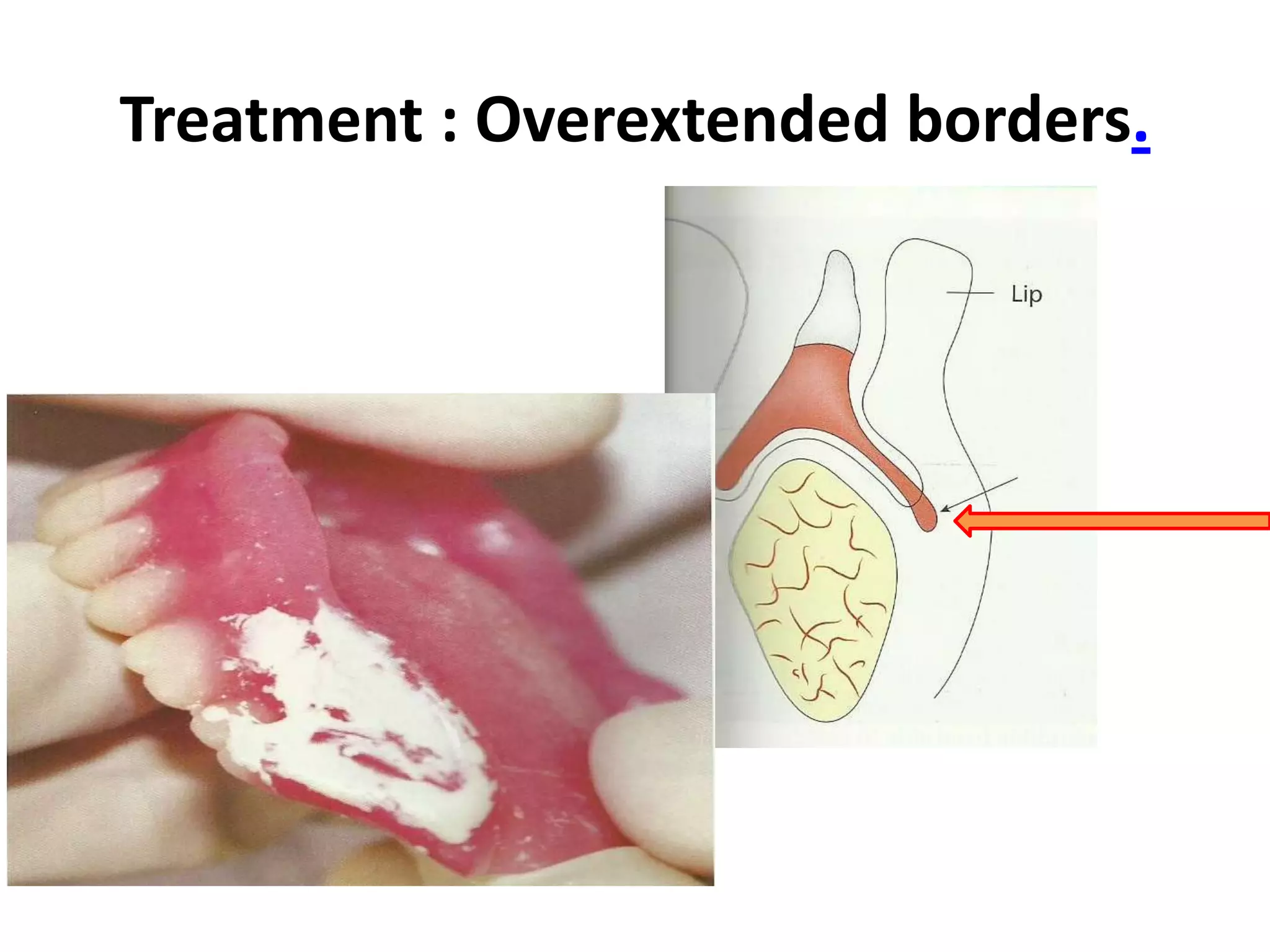 Treatment : Overextended borders.
 