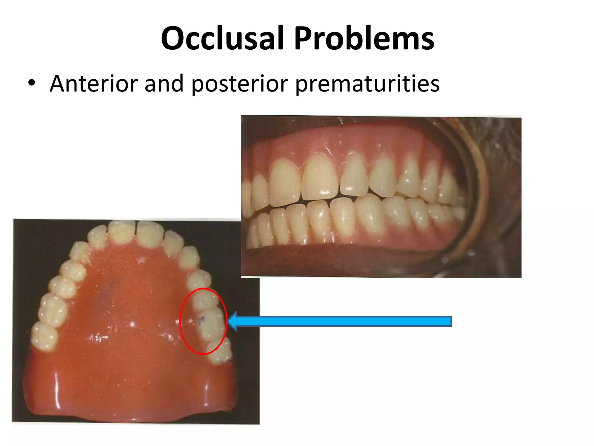 Occlusal Problems
• Anterior and posterior prematurities
 