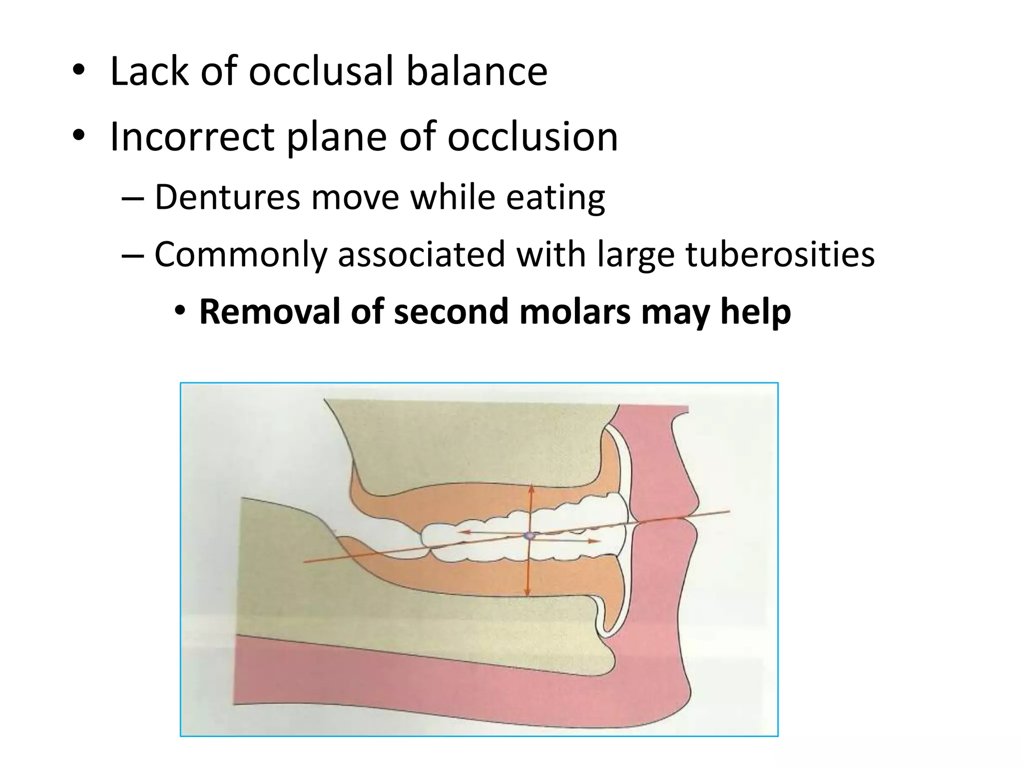 • Lack of occlusal balance
• Incorrect plane of occlusion
– Dentures move while eating
– Commonly associated with large tuberosities
• Removal of second molars may help
 