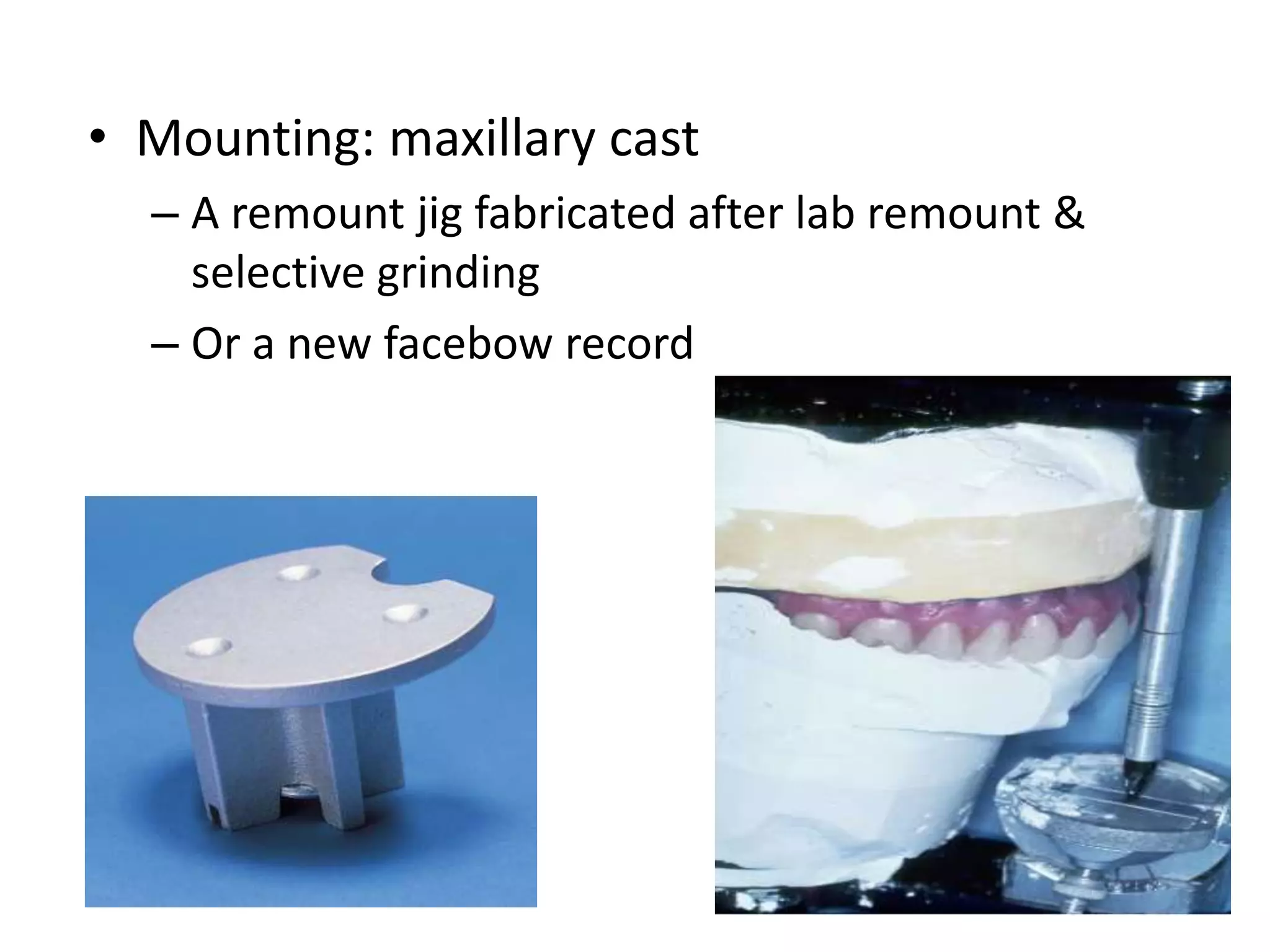 • Mounting: maxillary cast
– A remount jig fabricated after lab remount &
selective grinding
– Or a new facebow record
 