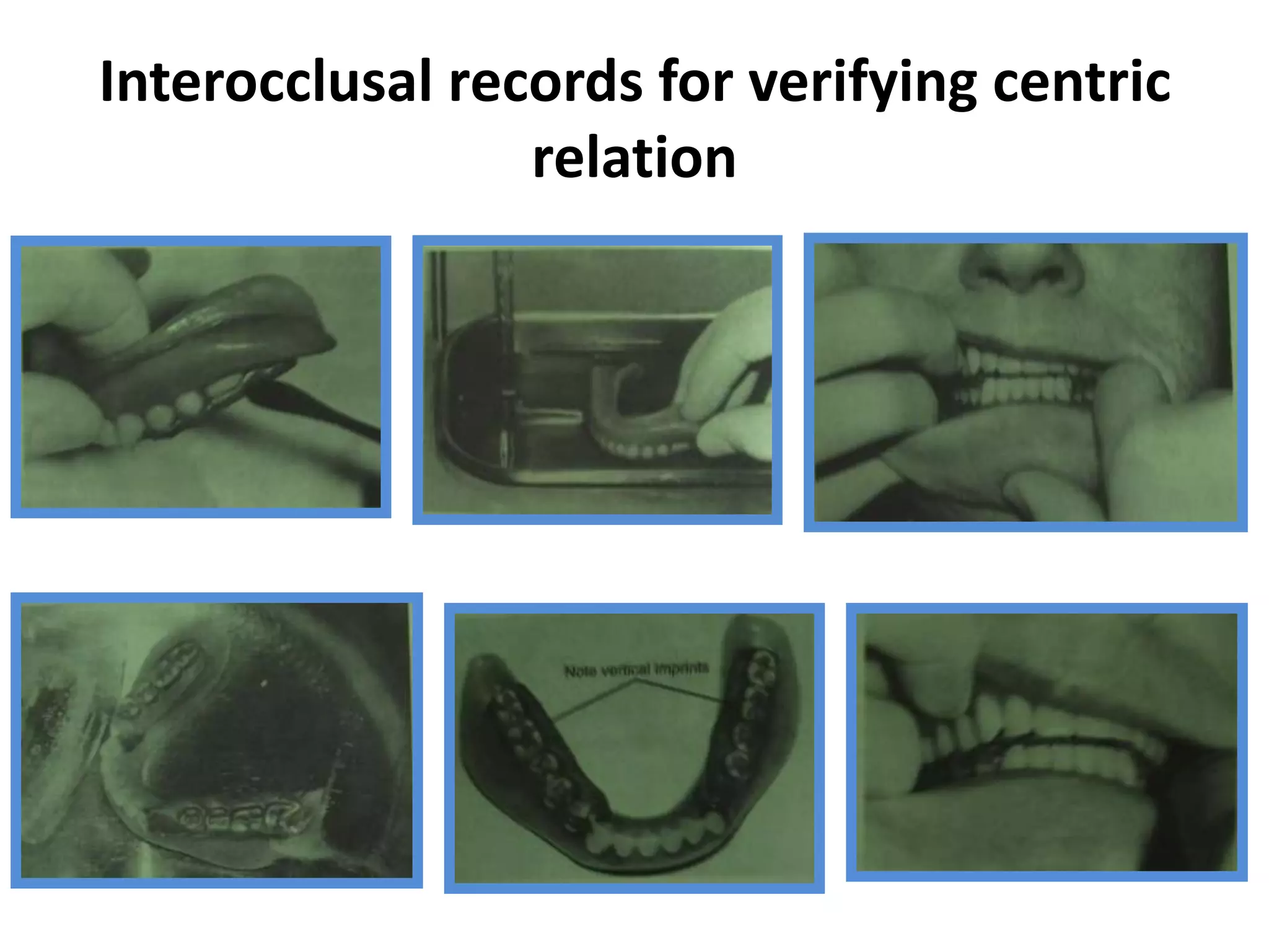Interocclusal records for verifying centric
relation
 