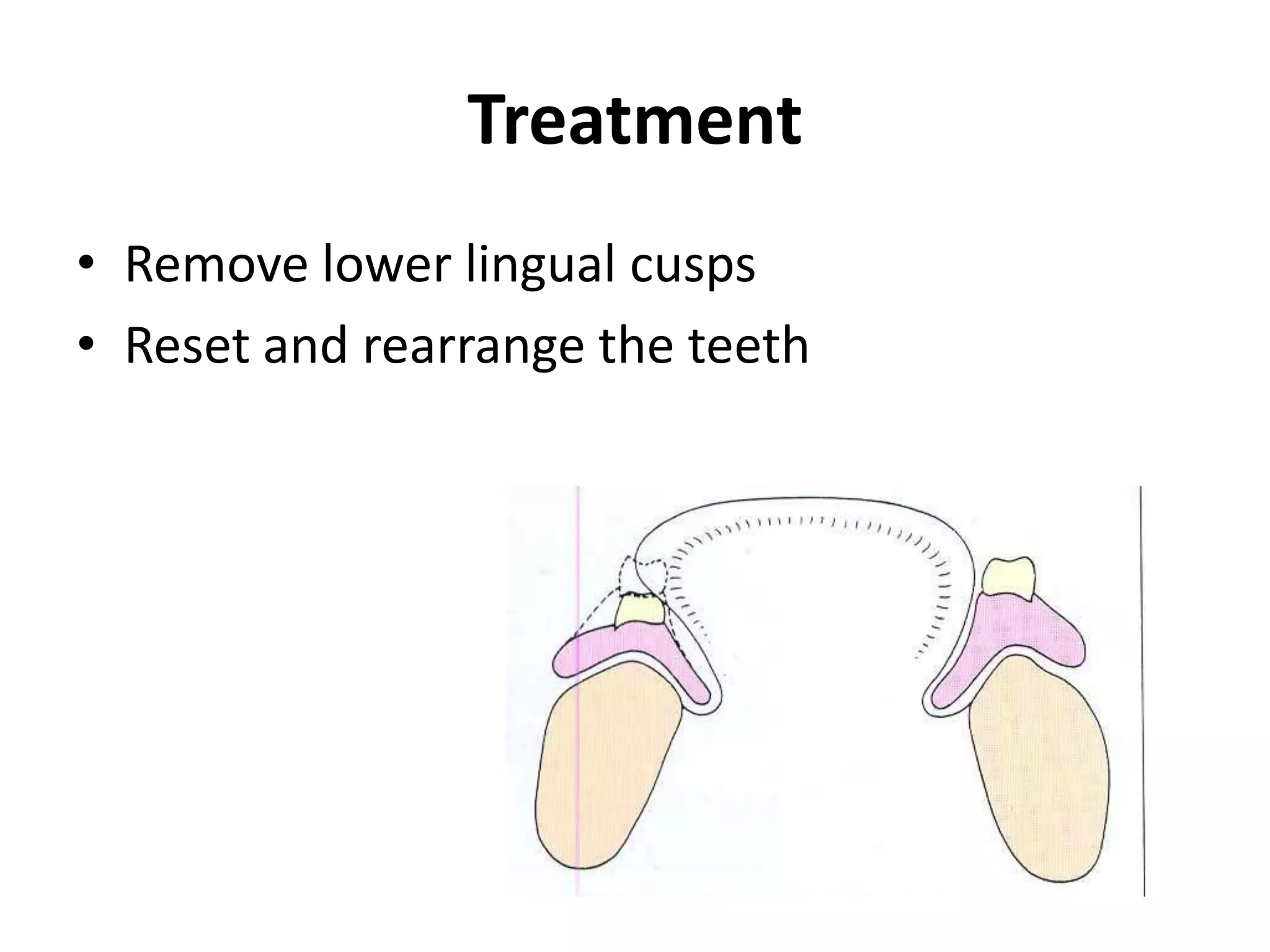 Treatment
• Remove lower lingual cusps
• Reset and rearrange the teeth
 