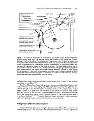 POSTMASTECTOMYAND POSTTHORACOTOMYPAIN 355
Medialpectoral nerveto the
pectoralis minor muscle
Lateral pectoral nerve to the
pectoraiis major muscle
Longthoracic nerve to the
serratus anterior muscle
Thoracodorsal nerve to the
latissimus dorsi muscle Breast
Figure 1. The origin of innervation of musculature around the breast. Medial and lateral
pectoral nerves arise from the brachial plexus and course to their respective muscles
(pectoralis minor and major). The long thoracic nerve arises from the brachial plexus and
courses down the medial axilla and down lateral chest wall to innervate the serratus anterior
muscle. The thoracodorsal nerve arises from the posterior cord of the brachial plexus and
courses in the posterior aspect of the axilla and down the posterolateral chest wall to
innervate the latissimus dorsi muscle. All of these nerves carry postganglionic sympathetic
fibers originating from the stellate and middle cervical ganglion. Damage to these nerves
during mastectomy may result in neuropathic pain. Also note the close relationship of the
breast and axilla to the brachial plexus. Radiation to the breast and axilla may damage
nerves described here as well as the brachial plexus.
well-described intercostobrachial nerve is the equivalent branch of the second
intercostal nerve (Fig. 2).lZ1
The lateral branches divide into anterior and posterior branches to innervate
further the rest of the breast (Fig. 3). Although it is routinely thought that the
anterior branch of the fourth lateral cutaneous nerve is the single nerve to the
there is a great deal of variation as to where the medial and lateral
branches unite. It is therefore not possible always to predict whether the innerva-
tion of the nipple and areola comes from the medial or lateral mammary nerves
or is shared by both.24,3b,78,'I2 Again, these are important factors when consider-
ing breast-sparing surgery in which the nipple is maintained.
Pathogenesisof Postmastectomy Pain
Postmastectomy pain is a complex problem that likely has a number of
contributing causes. The syndrome has long been thought to have a significant
 
