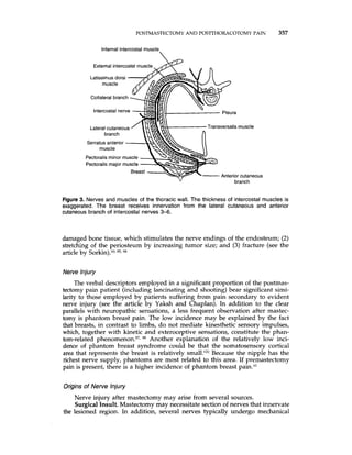 POSRvIASTECTOMYAND POSTTHORACOTOMY PAIN 357
Internal intercostal muscle
External intercostal muscle.
muscle
Collateral branch
Intercostal nerve
Lateralcutaneous w- Transversalismuscle
branch
Serratusanterior
muscle
Pectoralis minor muscle
Pectoralis major muscle
branchv
Figure 3. Nerves and muscles of the thoracic wail. The thickness of intercostal muscles is
exaggerated. The breast receives innervation from the lateral cutaneous and anterior
cutaneous branch of intercostal nerves 3-6.
damaged bone tissue, which stimulates the nerve endings of the endosteum; (2)
stretching of the periosteum by increasing tumor size; and (3)fracture (see the
article by Sorkin).lo,85, 9R
Nerve Injury
The verbal descriptors employed in a significant proportion of the postmas-
tectomy pain patient (including lancinating and shooting) bear significant simi-
larity to those employed by patients suffering from pain secondary to evident
nerve injury (see the article by Yaksh and Chaplan). In addition to the clear
parallels with neuropathic sensations, a less frequent observation after mastec-
tomy is phantom breast pain. The low incidence may be explained by the fact
that breasts, in contrast to limbs, do not mediate kinesthetic sensory impulses,
which, together with kinetic and exteroceptive sensations, constitute the phan-
tom-related phen~menon?~,99 Another explanation of the relatively low inci-
dence of phantom breast syndrome could be that the somatosensory cortical
area that represents the breast is relatively Because the nipple has the
richest nerve supply, phantoms are most related to this area. If premastectomy
pain is present, there is a higher incidence of phantom breast pain.I0
Origins of Nerve Injury
Nerve injury after mastectomy may arise from several sources.
Surgical Insult.Mastectomy may necessitate section of nerves that innervate
the lesioned region. In addition, several nerves typically undergo mechanical
 