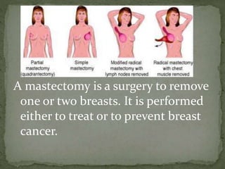 A mastectomy is a surgery to remove
one or two breasts. It is performed
either to treat or to prevent breast
cancer.
 