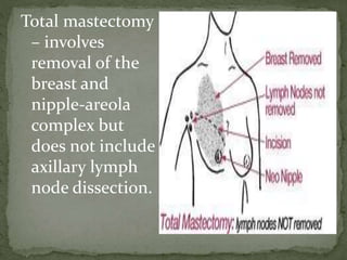 Total mastectomy
– involves
removal of the
breast and
nipple-areola
complex but
does not include
axillary lymph
node dissection.
 