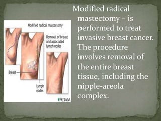 Modified radical
mastectomy – is
performed to treat
invasive breast cancer.
The procedure
involves removal of
the entire breast
tissue, including the
nipple-areola
complex.
 