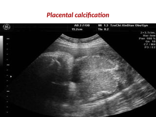 Placental calcification
 