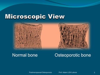 Normal bone                          Osteoporotic bone


       Postmenopausal Osteoporosis    Prof. Aslam LGH Lahore   5
 