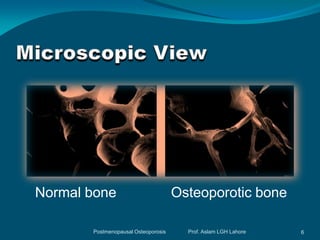 Normal bone                          Osteoporotic bone

       Postmenopausal Osteoporosis     Prof. Aslam LGH Lahore   6
 