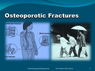 Postmenopausal Osteoporosis   Prof. Aslam LGH Lahore   7
 