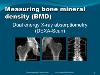 Dual energy X-ray absorptiometry
         (DEXA-Scan)




     Postmenopausal Osteoporosis   Prof. Aslam LGH Lahore   8
 