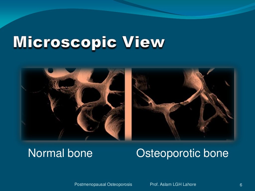 Postmenopausal osteoporosis