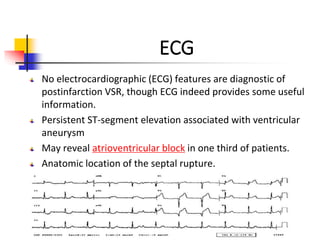 ECG
No electrocardiographic (ECG) features are diagnostic of
postinfarction VSR, though ECG indeed provides some useful
information.
Persistent ST-segment elevation associated with ventricular
aneurysm
May reveal atrioventricular block in one third of patients.
Anatomic location of the septal rupture.
 
