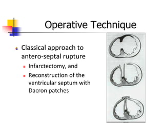 Operative Technique
Classical approach to
antero-septal rupture
Infarctectomy, and
Reconstruction of the
ventricular septum with
Dacron patches
 