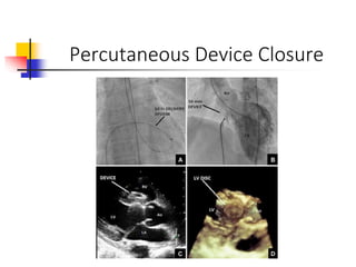 Percutaneous Device Closure
 