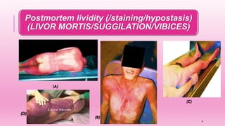 Postmortem lividity (/staining/hypostasis)
(LIVOR MORTIS/SUGGILATION/VIBICES)
(D)
6
 