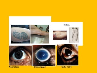 Normal eye Dilated pupil tache noire
 