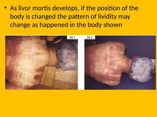 • As livor mortis develops, if the position of the
body is changed the pattern of lividity may
change as happened in the body shown
 