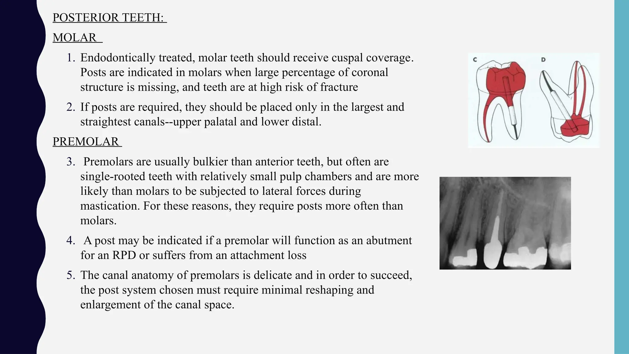Sindle Rpd post n core. in prosthodontics and dental science | PPTX