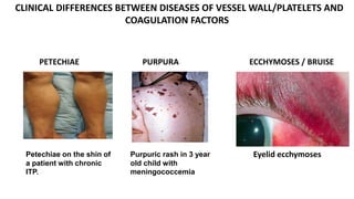 postneonatal bleeding disorder Dr. Obasohan.pptx