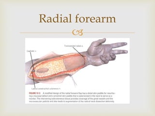 Radial forearm 
 
 
