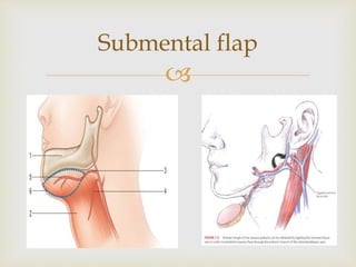 Submental flap 
 
 