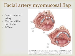 Facial artery myomucosal flap 
• Based on facial 
artery 
• Course within 
buccinator 
• 2x9 cm 
 